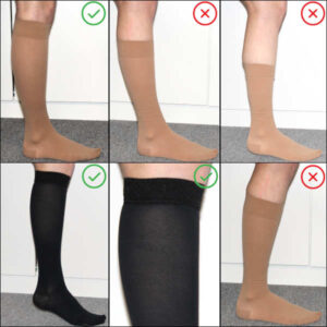 st�tzstr�mpfe nach op