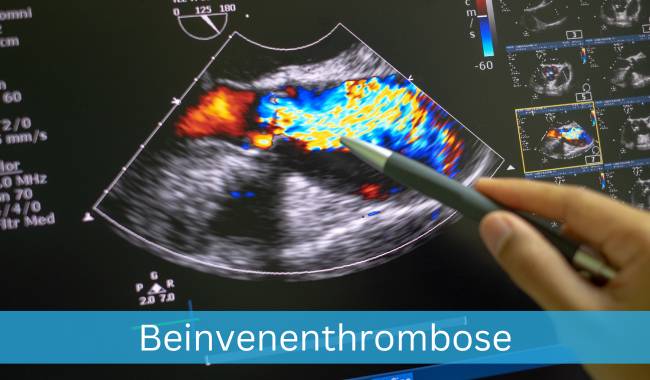 Beinvenenthrombose